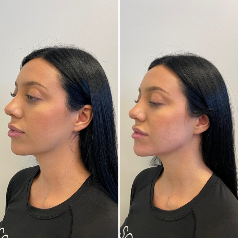 botox downers grove il