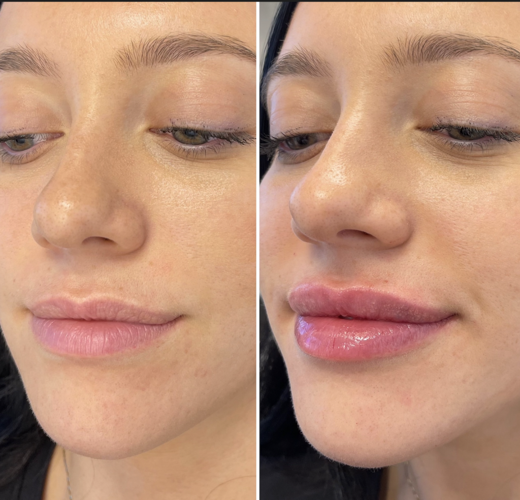 lip fillers downers grove