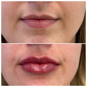 lip fillers downers grove