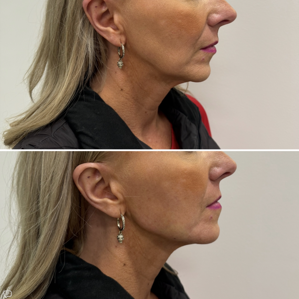 dermal fillers downers grove