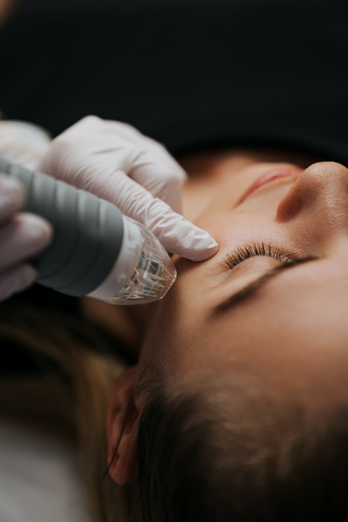 Microneedling with PRP