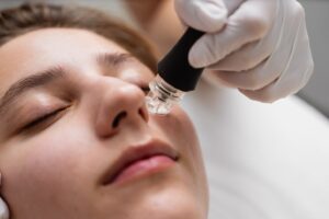 Microneedling with PRP