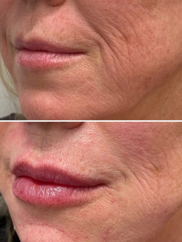 lip fillers downers grove