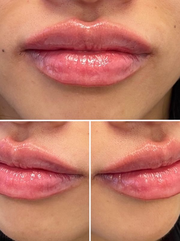 lip fillers downers grove
