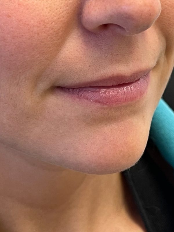 lip fillers downers grove
