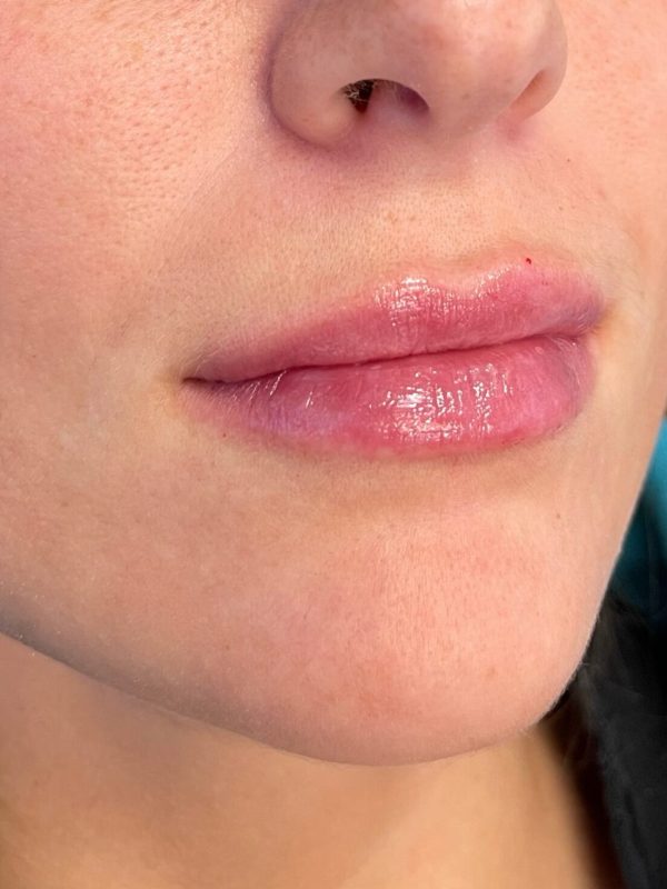 lip fillers downers grove