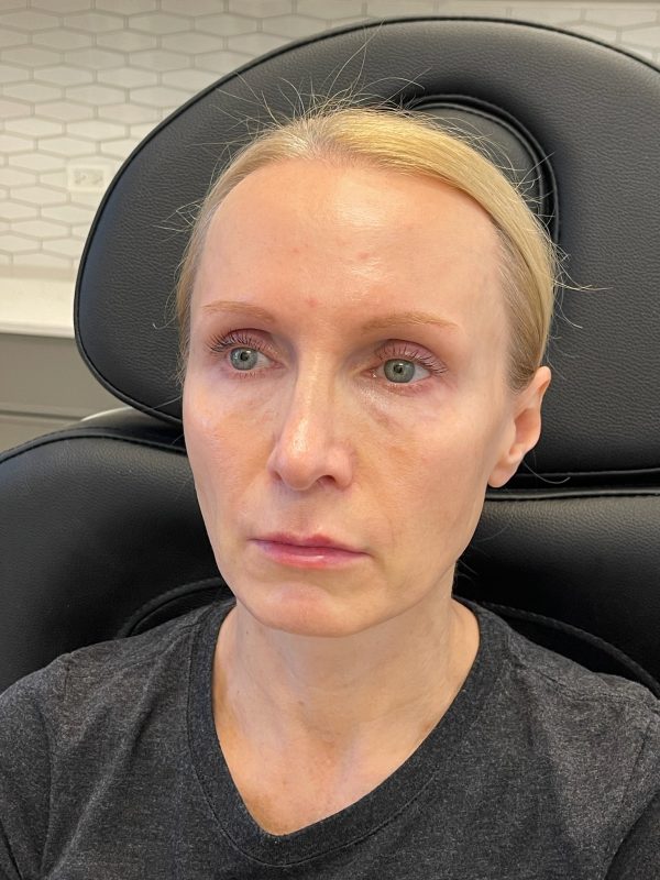 lip fillers downers grove