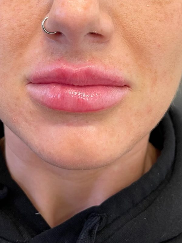 lip fillers downers grove