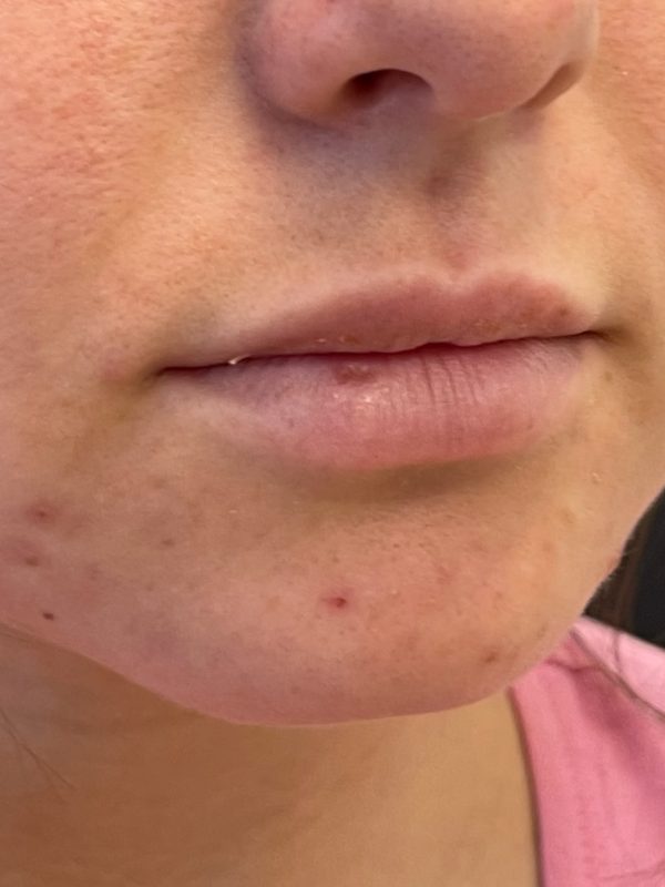 lip fillers downers grove