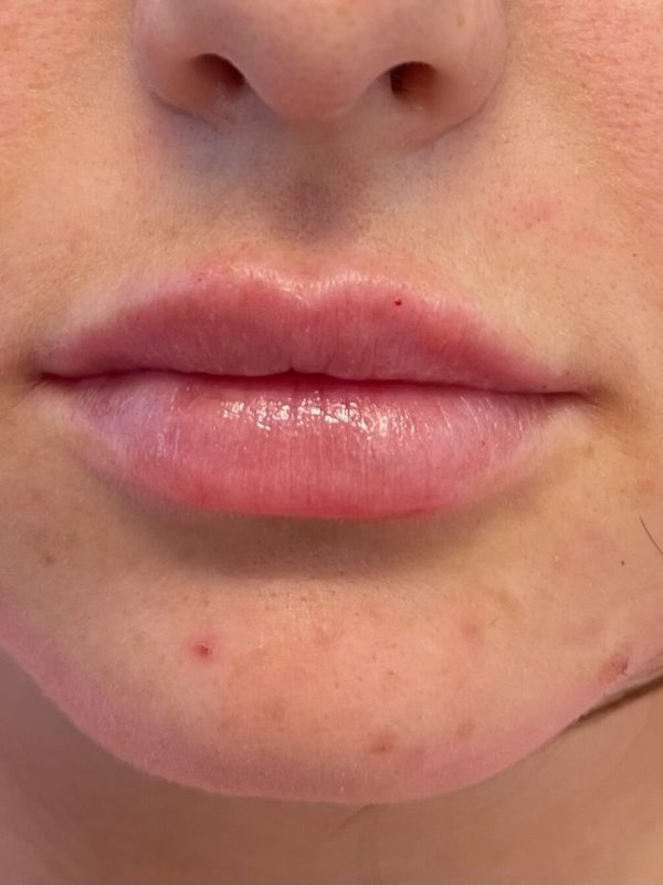 lip fillers downers grove