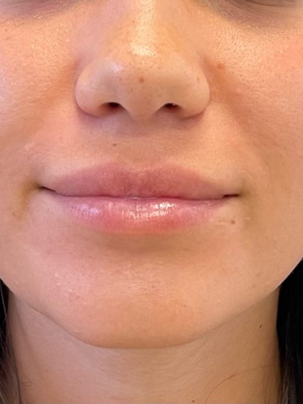 lip fillers downers grove
