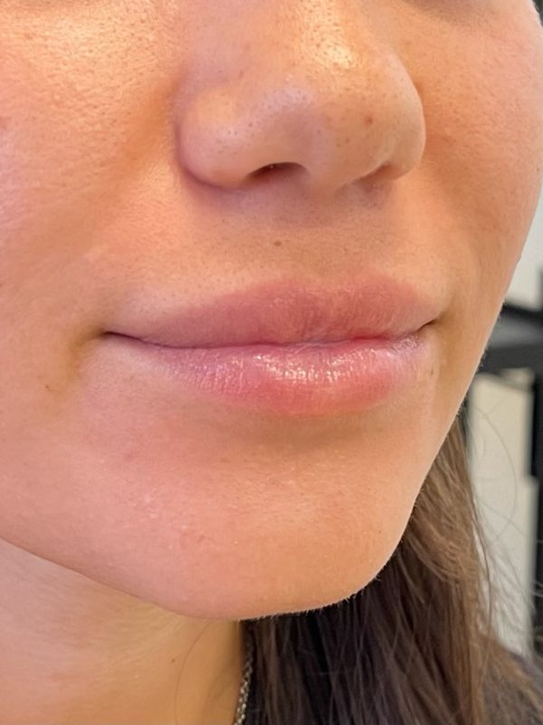 lip fillers downers grove