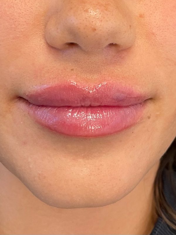 lip fillers downers grove