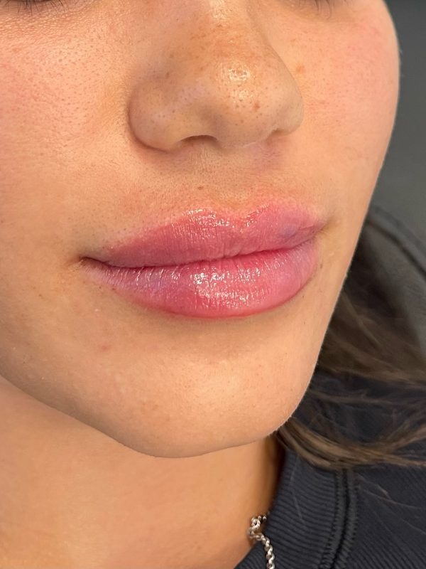 lip fillers downers grove